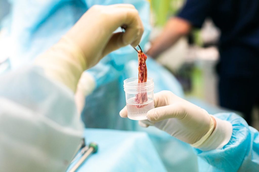 Операция по удалению эндометриоидной кисты в L-Clinic Извлеченная киста яичника отправляется на гистлогию